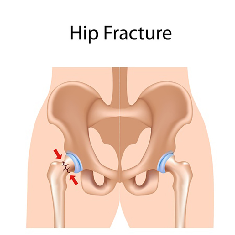 Medical illustration of a hip fracture caused by an accident.