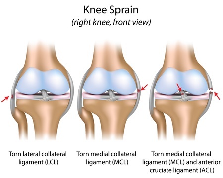 Ligament Injuries Sydney, NSW, ACL, MCL, PCL Tear Randwick