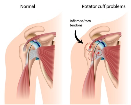 Rotator Cuff Injuries