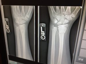 XRay of Broken Arm