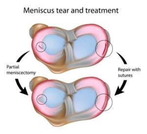 Meniscus tear and surgical treatment