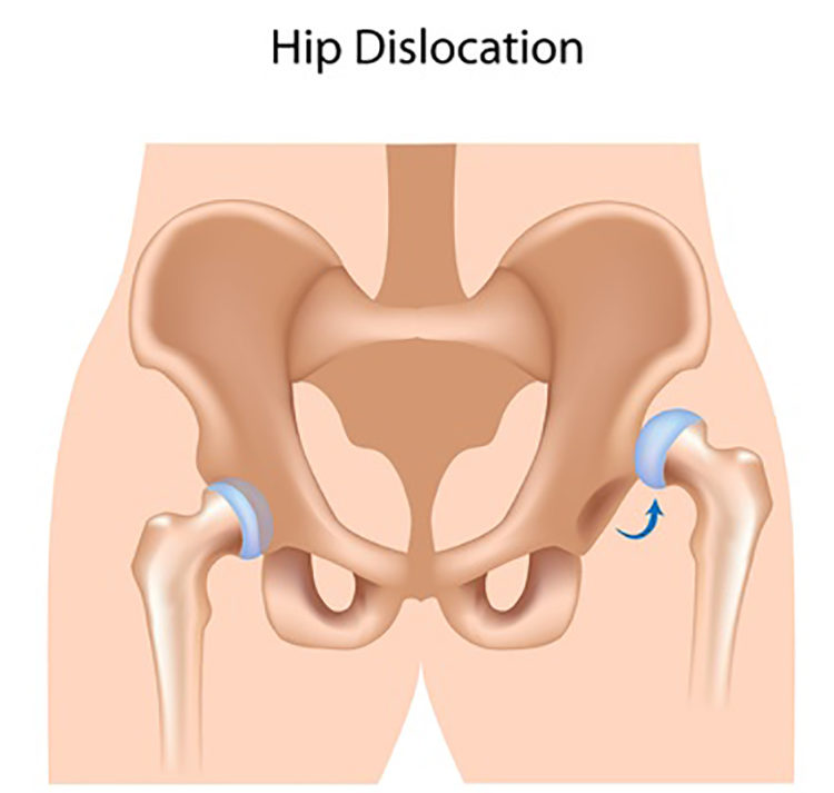 Medical illustration showing a dislocated hip.