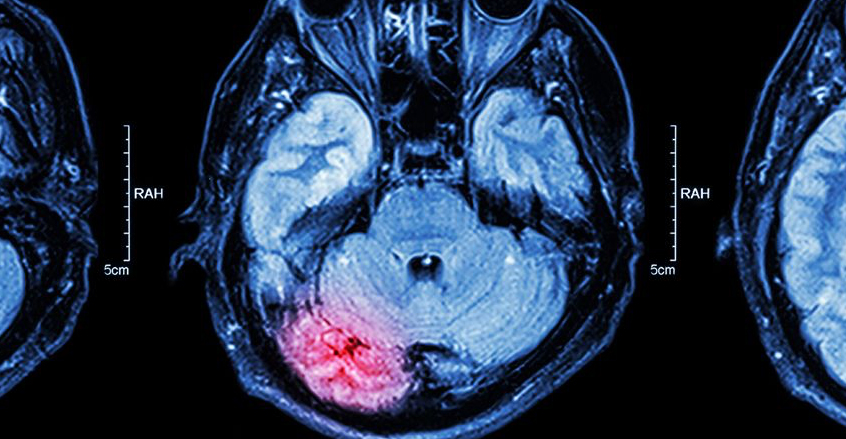 Brockton traumatic brain injury lawyer