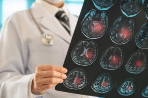 Long-Term Effects of a Brain Bleed
