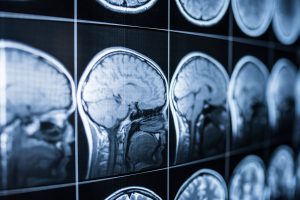 Neurological Disorders After An Injury 
