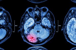 Why Brain Injury Cases Require Specialized Medical Testimony